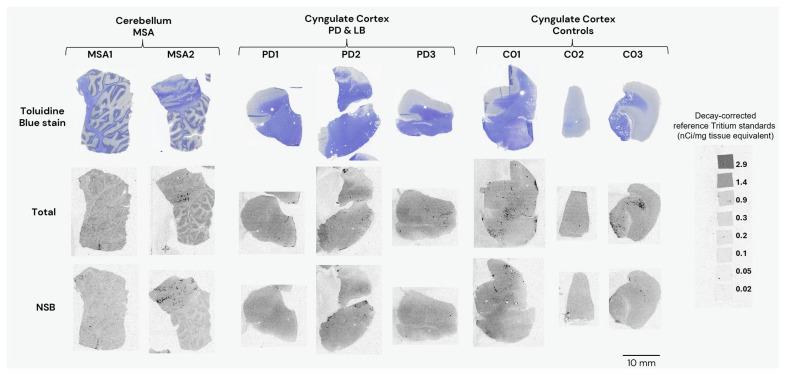 Representative images from autoradiography with [3H]GMC-058 (25 nM) on fresh-frozen tissue sections from patients with multiple-system atrophy (MSA), Parkinson’s disease (PD), Lewy-body disease (LB), and controls. Non-specific binding was measured with excess (5 µM) of blocker (GMC-044). Line scale: 10 mm.