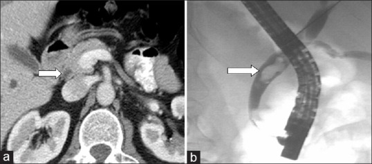 A 57-year-old man with fever and right upper quadrant pain. (a) IV contrast-enhanced MDCT transverse image with positive intraduodenal contrast filling. (b) Both observers failed to detect an ERCP-confirmed 14 × 6 mm mid-CBD stone (straight arrows). Despite its large size, this stone was likely missed due to isoattenuation to surrounding bile