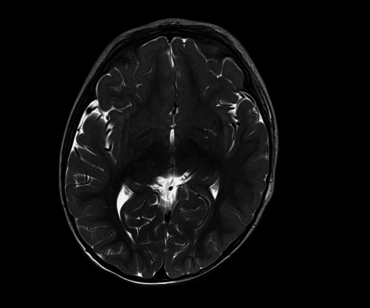 Axial T2-weighted MRI of the brain showing no edema, encephalomalacia, or abnormal signal intensity. No structural or temporal lobe abnormalities were identified.
