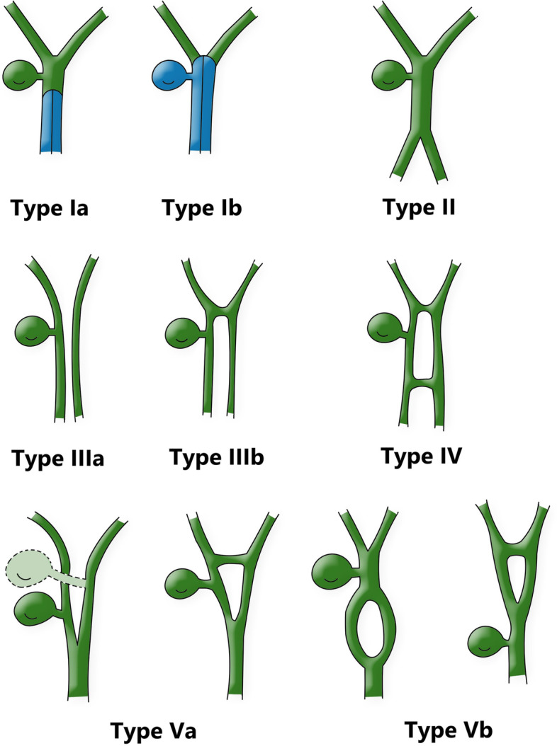 Double common bile duct classification.Modified classification from Choi et al. [7].Type I, Partially (a) or completely (b) septum within the lumen; Type II, the distal bile duct bifurcates to two independent drainages; Type III, double biliary drainage without any communication (a), with intrahepatic communication (b); Type IV, double biliary drainage with extrahepatic communicating channels; TypeV, duplicated commen bile ducts join as a single biliary drainage channels,the gallbladder is attached to the repeated biliary ducts or left or right hepatic duct (a), The gallbladder is connected to the common bile duct before or after separation (b)