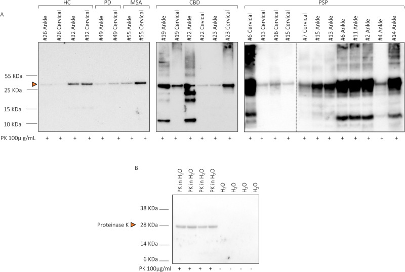 Western blot analysis of TauK18-SAA end-products after digestion with Proteinase K.A Band profiles of representative cases in each disease group in ankle and cervical sites are shown. The head arrow indicates that the band at 28 kDa might be partially due to an unspecific signal of PK. B Technical control confirming PK unspecific signal at 28 KDa. Experiments were performed three times, and gels were processed in parallel.