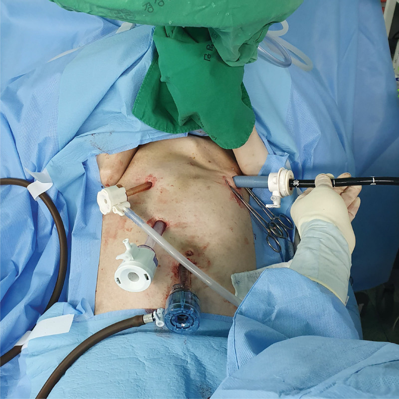 Laparoscopic port position in the operation room. An endoscope is introduced through the 15-mm port, which is inserted in the left upper quadrant.