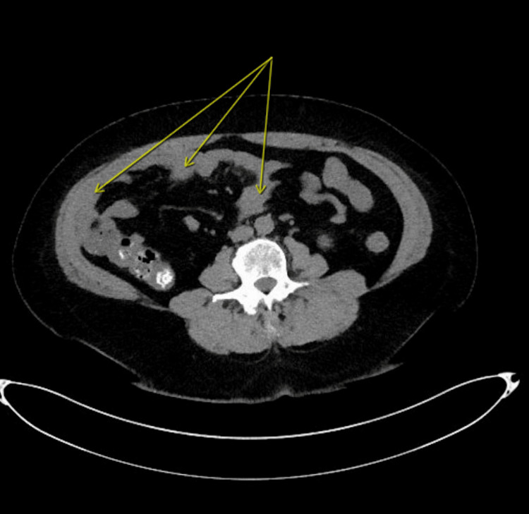 CT of the abdomen and pelvis without contrastImaging demonstrates wall thickening of multiple small bowel loops (arrows) suggestive of enterocolitis.