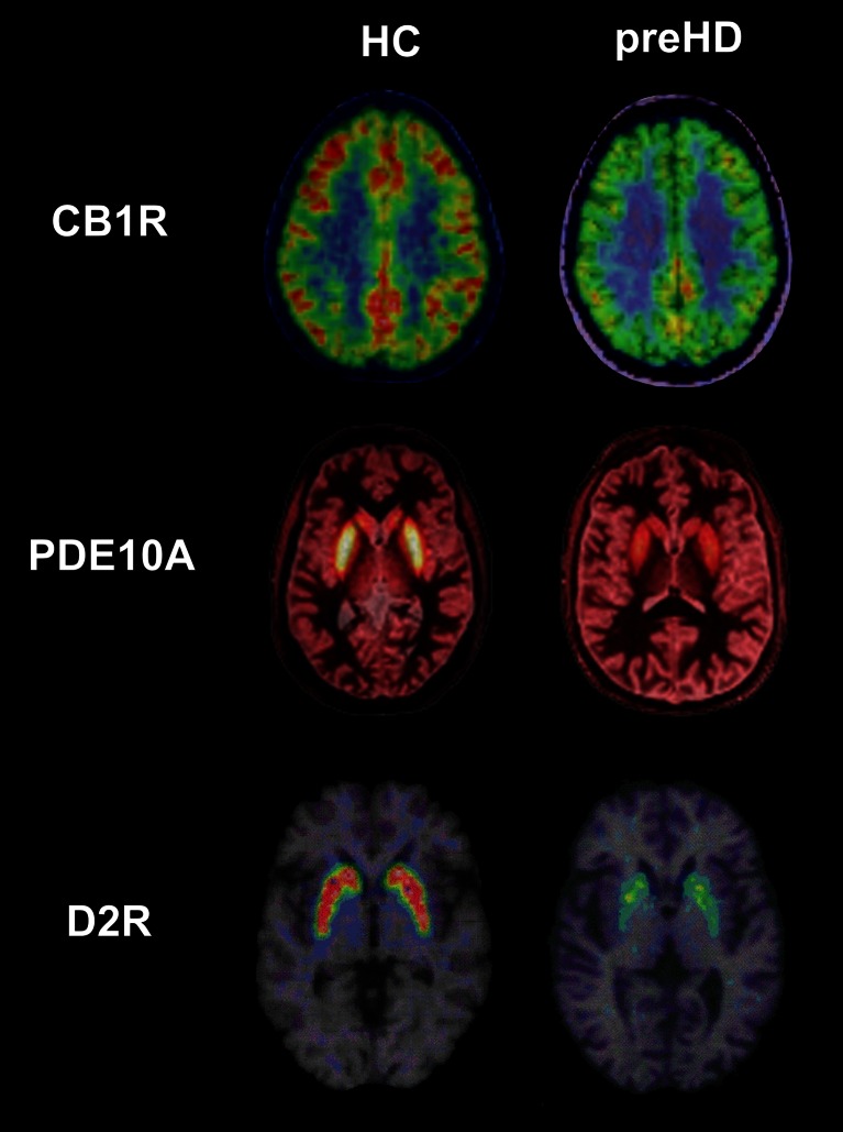 Example PET images in healthy controls (HC) and premanifest Huntington’s disease gene carriers (preHD). Axial [11C]MePPeP, [11C]IMA107, [11C]raclopride images in stereotaxic space overlaid onto the T1-weighted MNI template show decreased cortical CB1 receptor, striatal PDE10A and striatal D2 receptor binding in the preHD subjects compared to the healthy controls . Images from our data