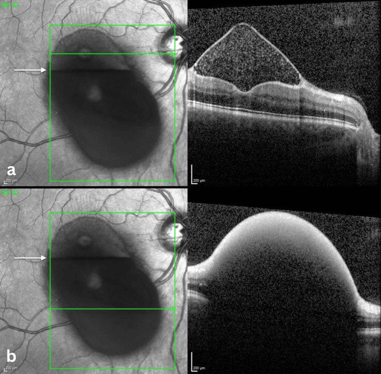 Spectral-Domain Optical Coherence Tomography of Premacular Subhyaloid HemorrhageSpectral-domain optical coherence tomography (SD-OCT; Heidelberg) of the right eye showing two scans obtained at different levels of the premacular hemorrhage. The upper scan (a) passes above the horizontal fluid–fluid level (arrow) through the more translucent layer and demonstrates a well-demarcated triangular preretinal cavity between the internal limiting membrane (ILM) and the posterior hyaloid, containing hyperreflective material consistent with suspended blood elements. The lower scan (b) passes below the fluid–fluid level (arrow) and shows a dome-shaped, dense hyperreflective preretinal lesion producing marked posterior shadowing, which obscures visualization of the underlying retinal structures.