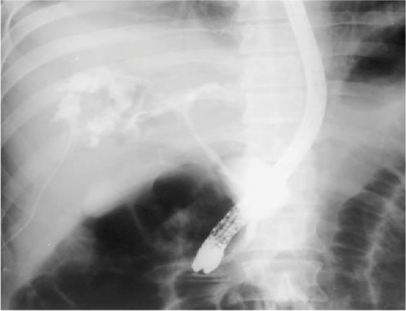 Extravasation of the contrast into the abscess cavity proofing the linkage with the biliary tree