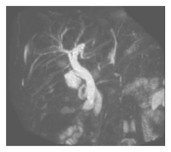 MRCP abdomen demonstrating intra‐ and extrahepatic biliary ductal dilatation. The extrahepatic bile duct measures 13 mm. There is no choledocholithiasis.