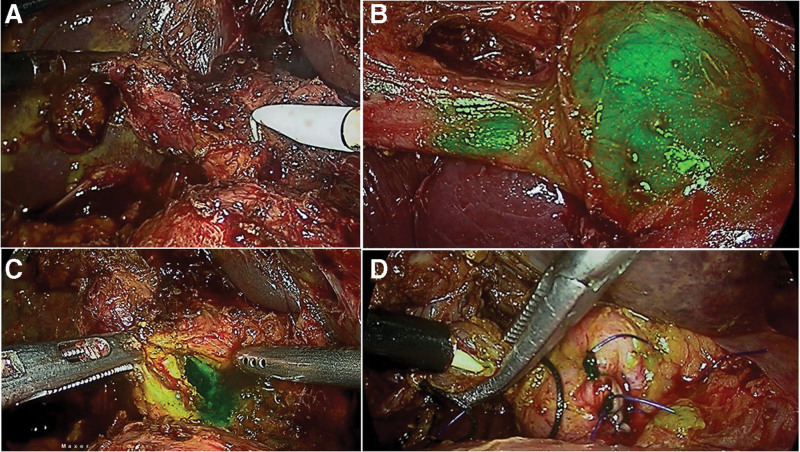 (a) Pure laparoscopic image showing choledochoduodenal fistula; (b) Bile leak from CBD side of fistula after its takedown which is not clearly visible; (c) Fluorescent bile leak clearly visible in the corresponding NIRFA image; (d) The same leak in a NIRF image. CBD = common bile duct, NIRFA = near infrared fluorescence augmented.