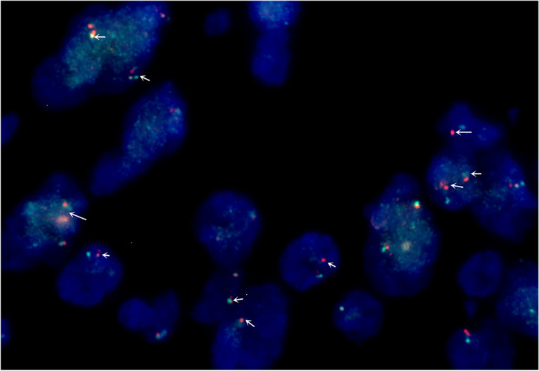 Immunofluorescence in situ hybridization (FISH) indicated that ALK was represented by a mainly orange-green signal or only an orange signal, indicating positive results