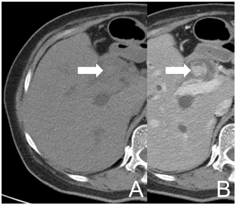 UCOGC of CHD and CBD in a 66-year-old female, 4 months after the initial presentation. The axial CT images show a mass (arrow) in CBD, demonstrating relatively high density on the pre-contrast image (A) and heterogeneous enhancement on the post-contrast image (B). The imaging findings are compatible with a neogrowth with hemorrhage.