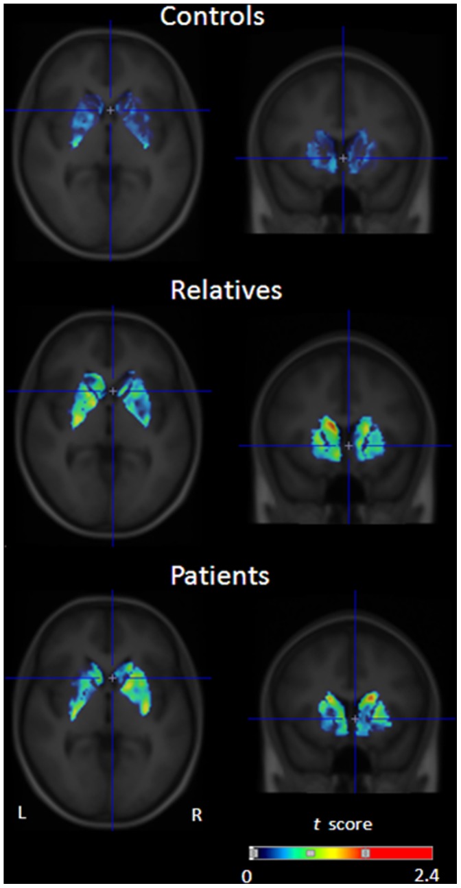 Mean statistical parametric t map of γ in sagittal (left) and coronal (right) sections overlaid on a MRI template, showing Δ9-THC-induced 18F-fallypride displacement at the level of the striatum (x = 0, y = 11, z = −4) for controls (top row, n = 9), relatives (middle row, n = 8) and patients (bottom row, n = 7, one subject was excluded from this analysis due to anomalous (non)physiological values).The image is thresholded for visualization purposes (maximum t obtained for controls, relatives and patients, respectively: 1.15, 2.6, and 2.7).